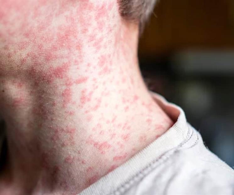 Activan aviso epidemiol&oacute;gico tras 45 casos de sarampi&oacute;n en Chiapas