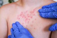 Lidera M&eacute;xico a Am&eacute;rica Latina en casos de sarampi&oacute;n durante 2025