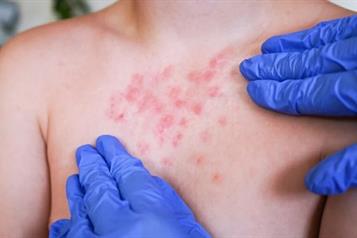 Lidera M&eacute;xico a Am&eacute;rica Latina en casos de sarampi&oacute;n durante 2025