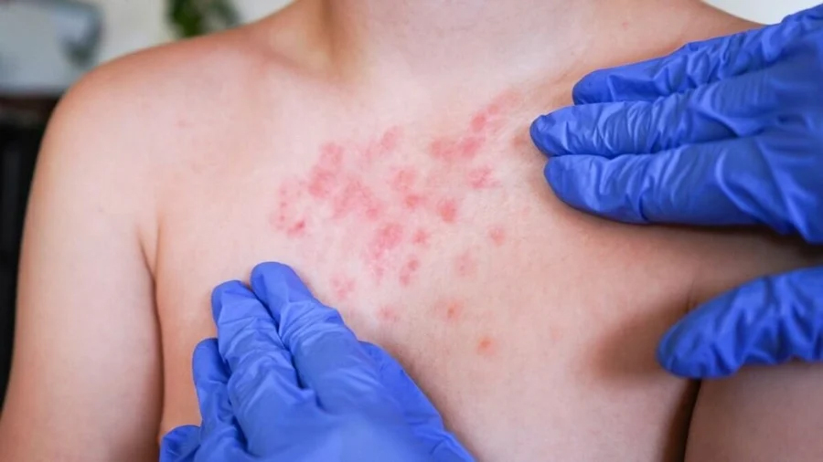 Lidera M&eacute;xico a Am&eacute;rica Latina en casos de sarampi&oacute;n durante 2025