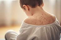 Cierran 8 escuelas por sarampi&oacute;n en cuatro municipios de Jalisco