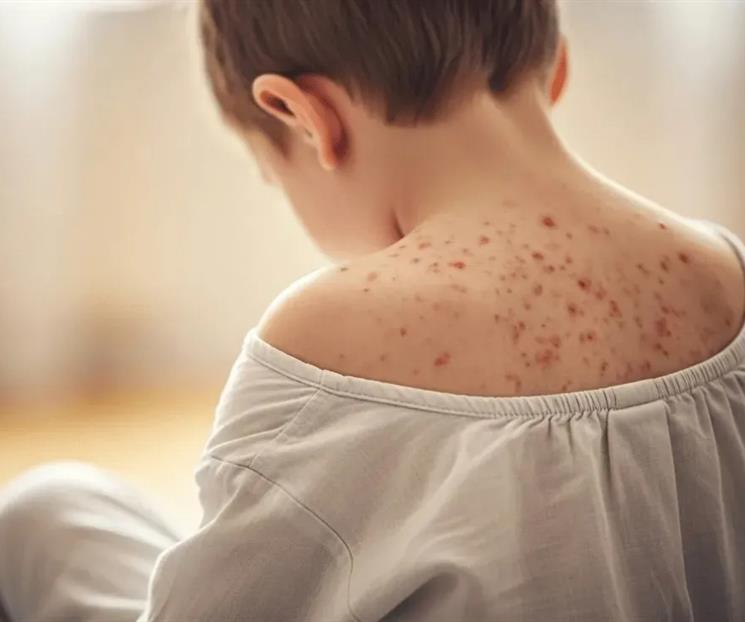 Cierran 8 escuelas por sarampión en cuatro municipios de Jalisco Cierran 8 escuelas por sarampión en cuatro municipios de Jalisco