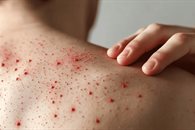 Suma NL tres casos de sarampi&oacute;n en el a&ntilde;o