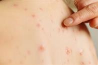 Remedios que existen para reducir los síntomas del sarampión Remedios que existen para reducir los síntomas del sarampión