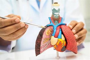 Lanza NL programa para detecci&oacute;n de c&aacute;ncer de pulm&oacute;n con IA