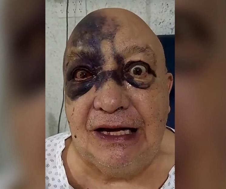 ¿Qué le paso al comediante Luis de Alba en el rostro? ¿Qué le paso al comediante Luis de Alba en el rostro?